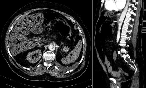Fig. 5. Fig. 5. Abdominal CT angiography shows portal vein gas and the embolus (arrows) in the origin of the celiac axis, which is the cause of massive intestinal ischemia. performed.
