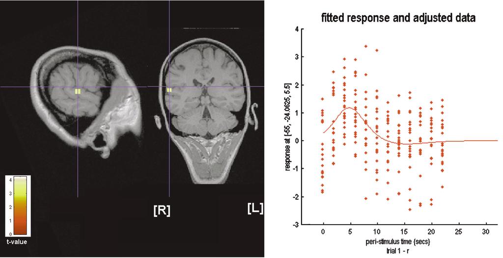998 gions known to be involved in higher order processing of an auditory signal were not detected.