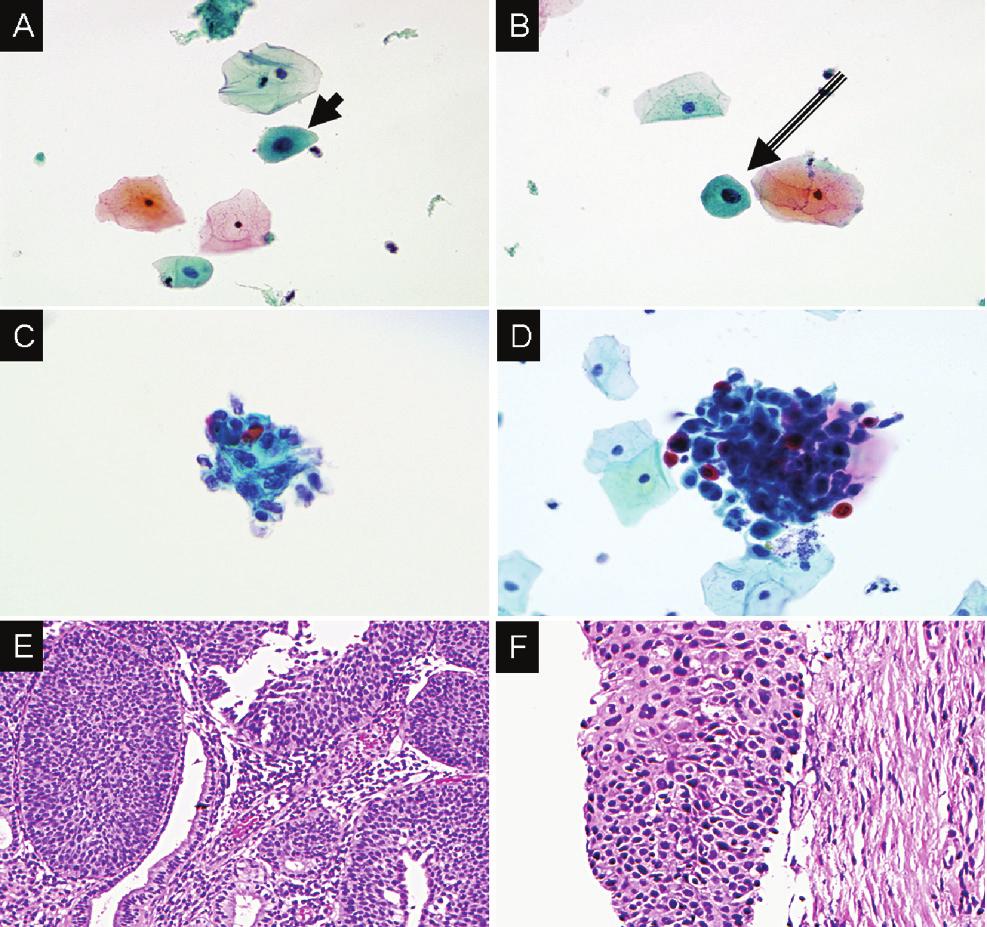 Figure. Cytologic and histologic features HRHPV+ lesions. The photomicrographs in Figure shows two different patients as they progressed from ASC-US to severe dysplasia.