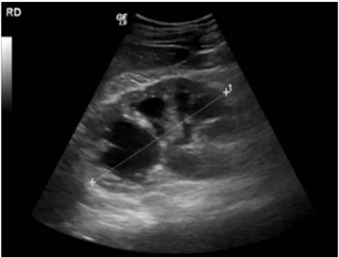 362 Chronic Kidney Disease 6.6 Renal ultrasonography Koch et al., performed renal ultrasound scans in a consecutive series of 556 elderly men with LUTS. 14 (2.
