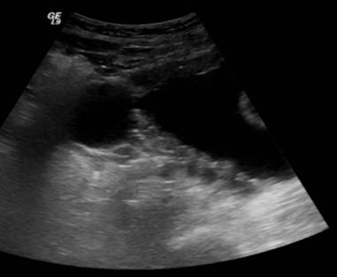 7 Bladder ultrasonography Chronic urinary retention leads to bladder wall thickening with trabeculations via smooth muscle hypertrophy and connective tissue infiltrates (Jones, Gilpin et al. 1991).