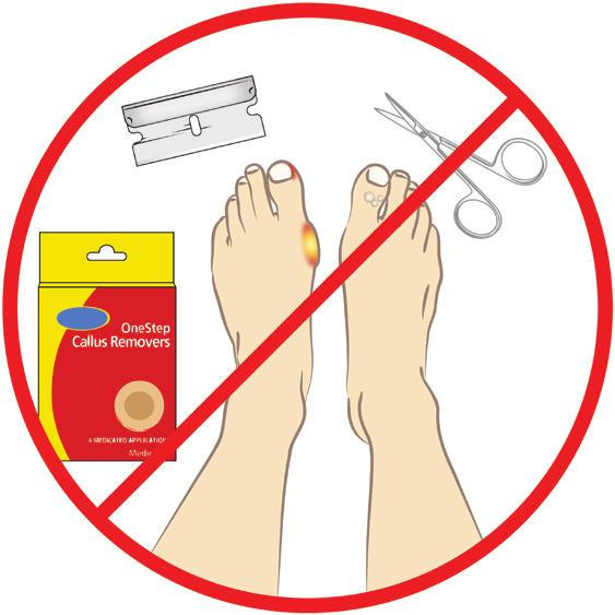 Do not cut your own corns and calluses, or