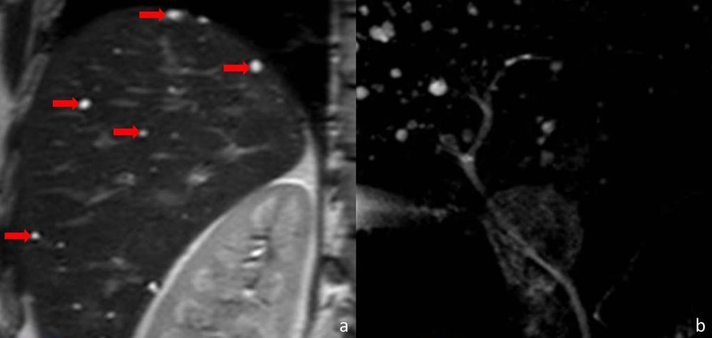 Fig. 4: (a) Coronal T2-weighted MR