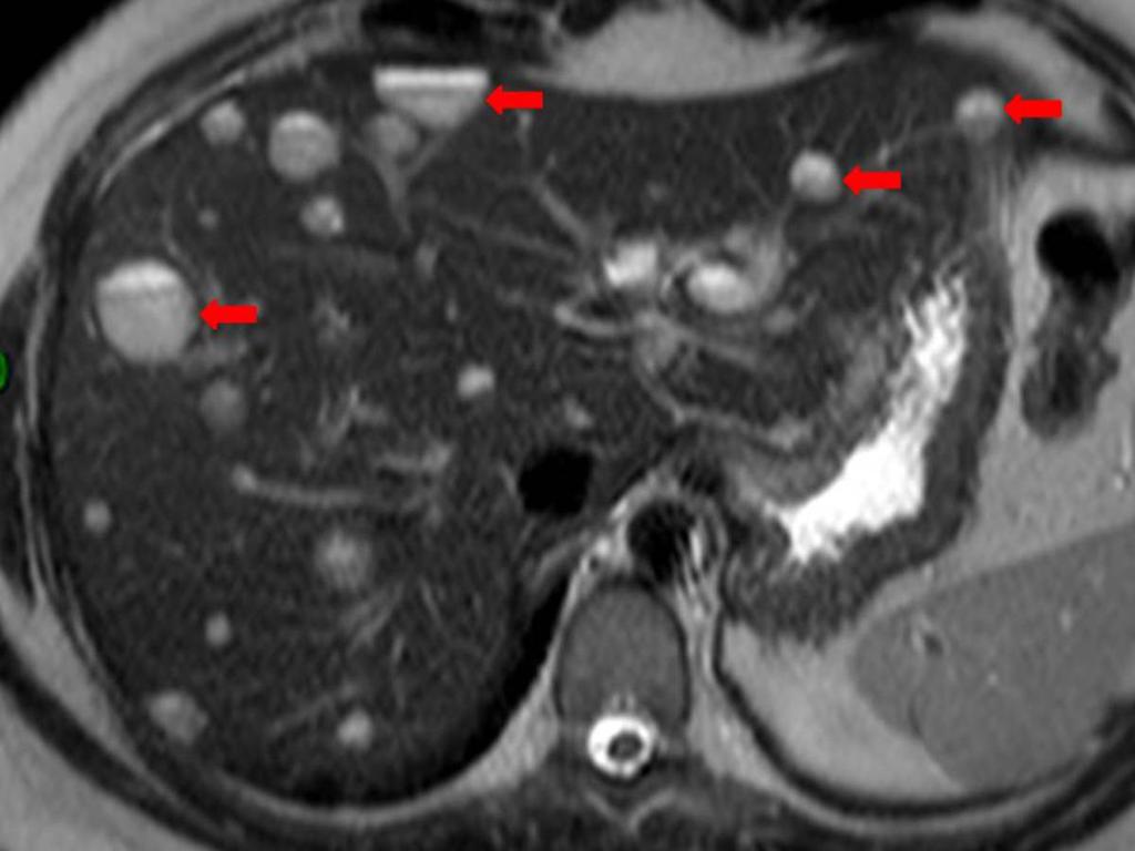 Fig. 5: Axial unenhanced T1-weighted MR image of a patient with Caroli disease, showing multiple hypointense cystic structures (arrows), corresponding to saccular dilatations of the biliary