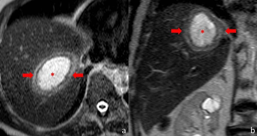 9: Contrast-enhanced abdominal CT showing a pyogenic abscess in the right lobe of the liver, with a peripheral hyperenhancing wall