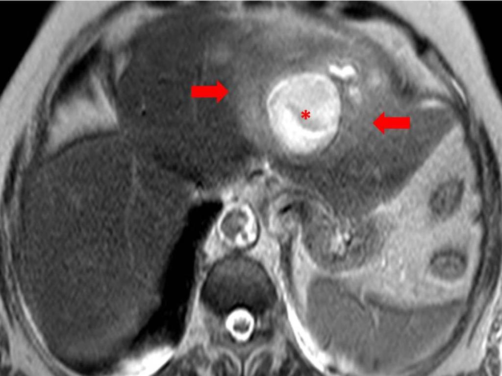 Fig. 11: Axial T2-weighted MR image of an hepatic abscess with a central cystic area (*)