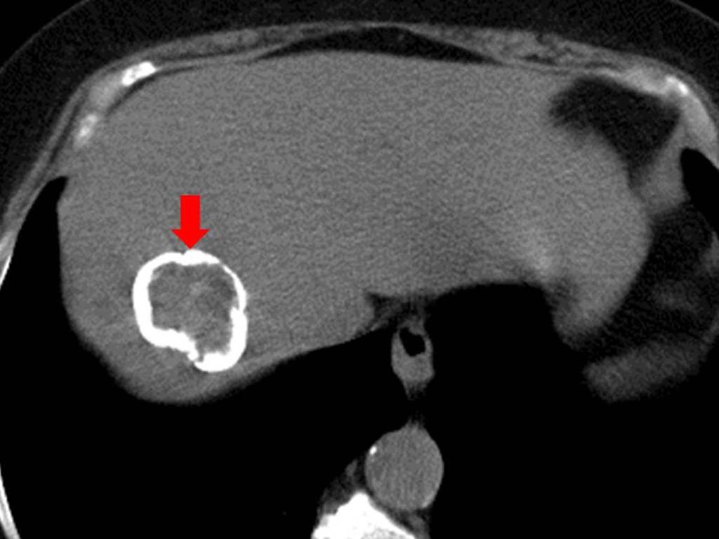 Fig. 12: Unenhanced abdominal CT showing a peripherally calcified hydatid cyst (arrow) in the right