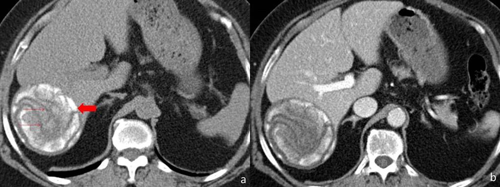 13: (a) Unenhanced abdominal CT showing a large hydatid cyst in the right lobe of the liver, with
