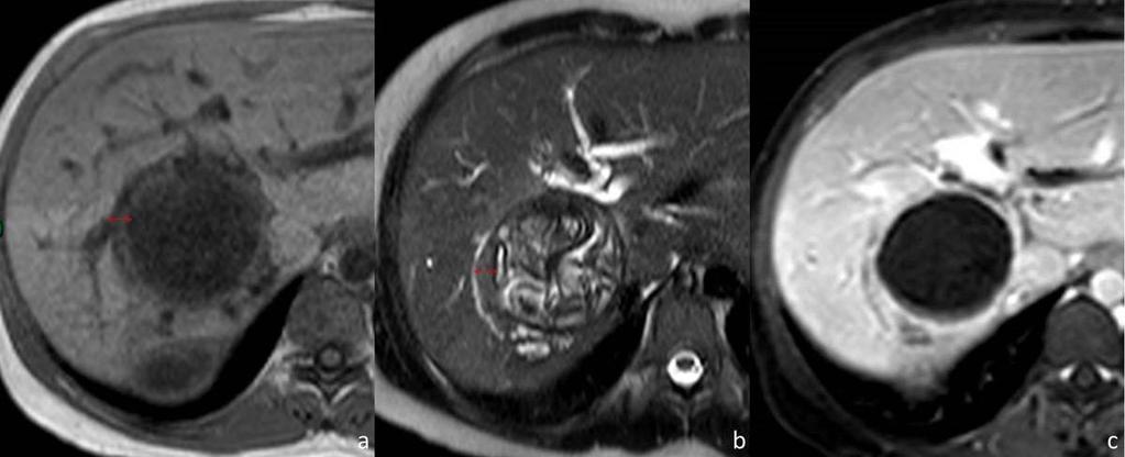 Fig. 14: (a)-axial unenhanced T1-weighted, (b) axial T2-weighted, (c)-axial contrastenhanced T1-weighted MR images showing a large hydatid cyst in the right lobe of the liver.