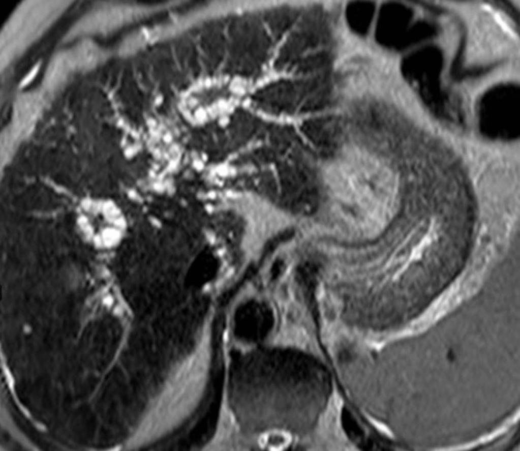 Fig. 15: Axial T2-weighted MR image of a patient with advanced cirrhosis,