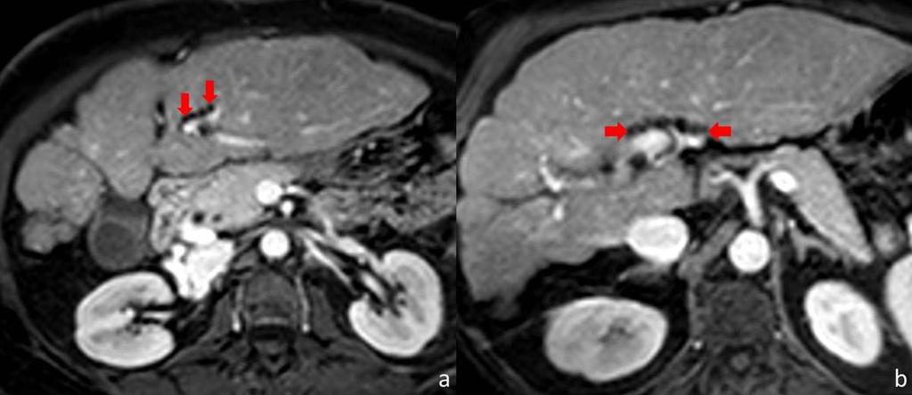 Fig. 16: Axial contrast-enhanced T1-weighted MR images in a patient with advanced cirrhosis show some peribiliary cysts with no