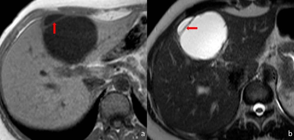 (a) on axial unenhanced T1-weighted image, the lesion shows homogeneous low signal intensity.