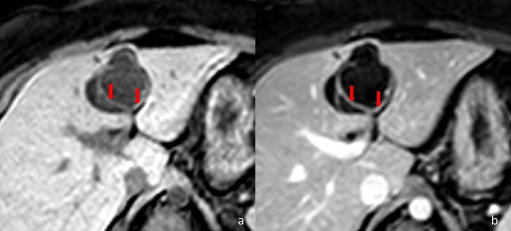 Some septa are seen (arrows) within the cystic lesion. Fig.