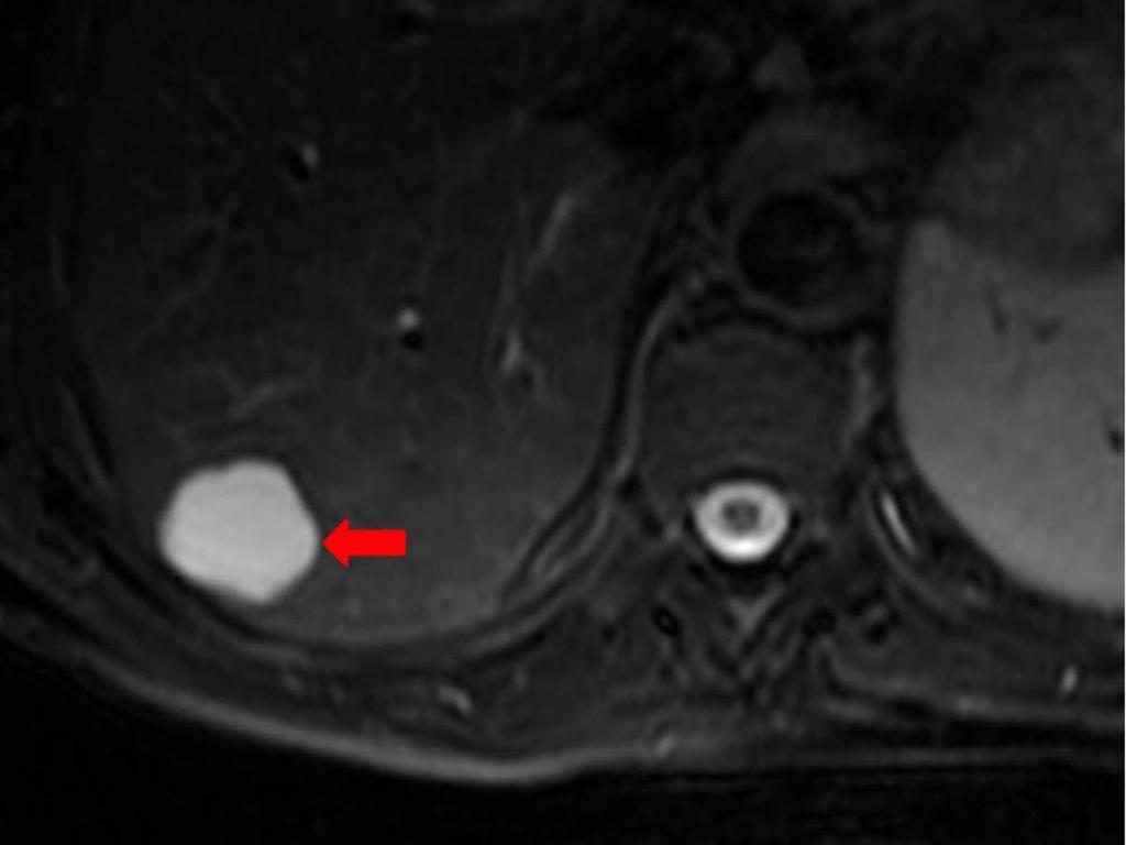 Fig. 2: Axial T2-weighted MR image showing a simple hepatic cyst (arrow). Fig.