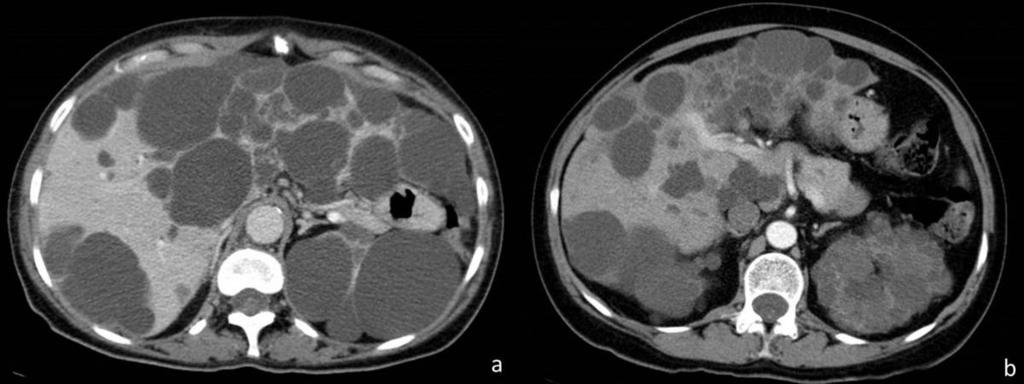 showing multiple simple cystic lesions in the liver and kidneys.