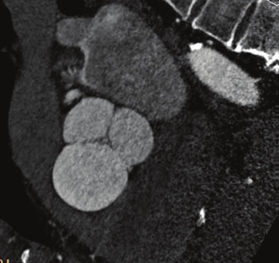 2 Echocardiography Cardiac computed tomography Truncus pulmonalis Aorta ascendens RVOT LVOT Right ventricle (a) (b) (e) (f) Aorta ascendens LVOT LAD RCA (c) (d) (g) (h) Figure 1: Comparison of