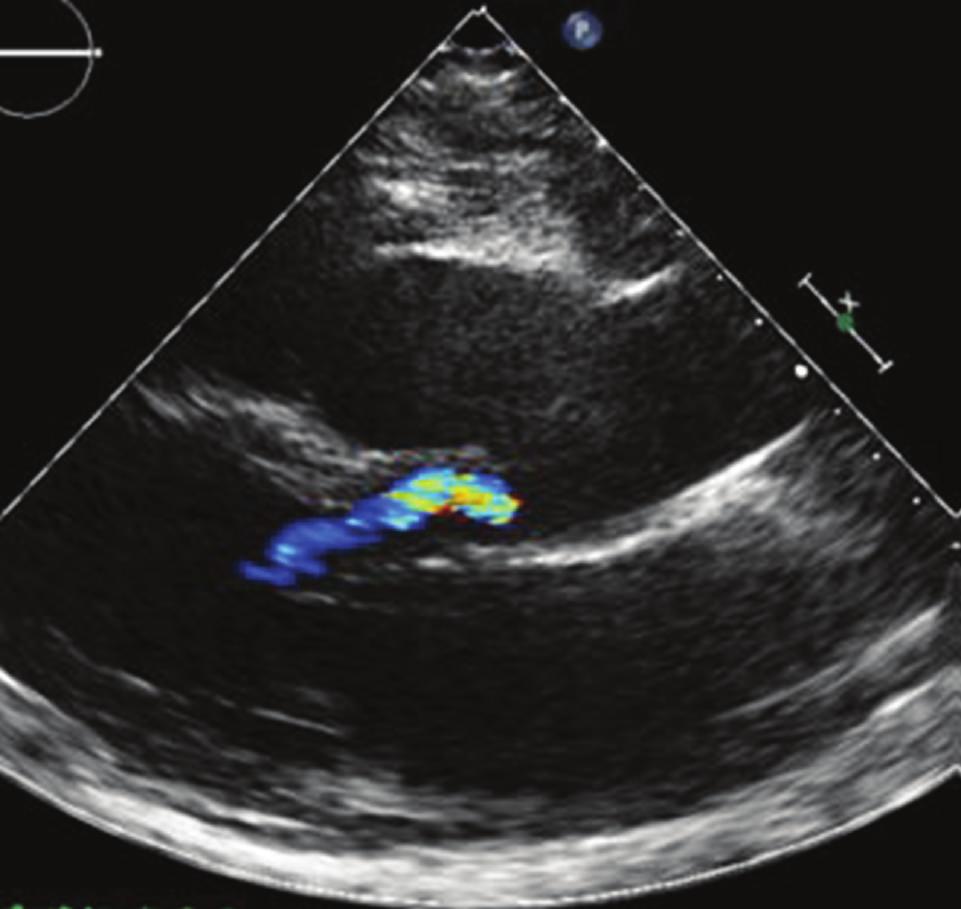 Hereby, an extremely asymmetric dilatation of the right coronary aortic cusp was observed, causing severe compression of the RV and of the RV outflow tract (Figures 1(e) 1(h)).