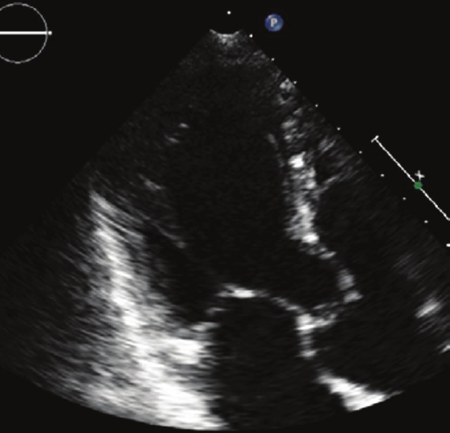 After review of echocardiographic acquisitions, the blood flow detected between the LV base and RV (mimicking VSD) was interpreted as turbulent inflow from the left ventricle (LV) into the ectatic