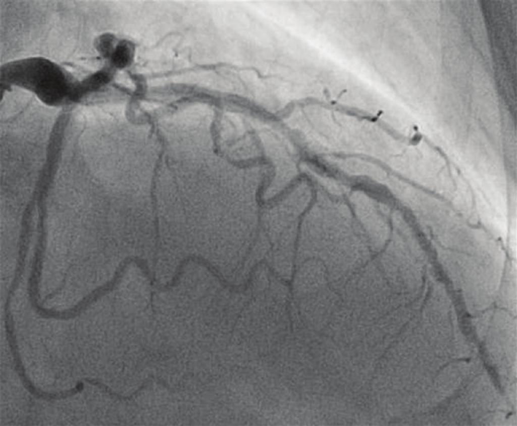 3 Coronary and bulbus angiography RAO 26 CRA 31 RAO 26 CAU 30 LAD LCA (a) (b) RAO 33 CAU 0 RCA LAO 47 CRA 0 Aortic bulb (c) (d) Figure 2: Severe coronary three-vessel disease (a) (c) and annuloaortic
