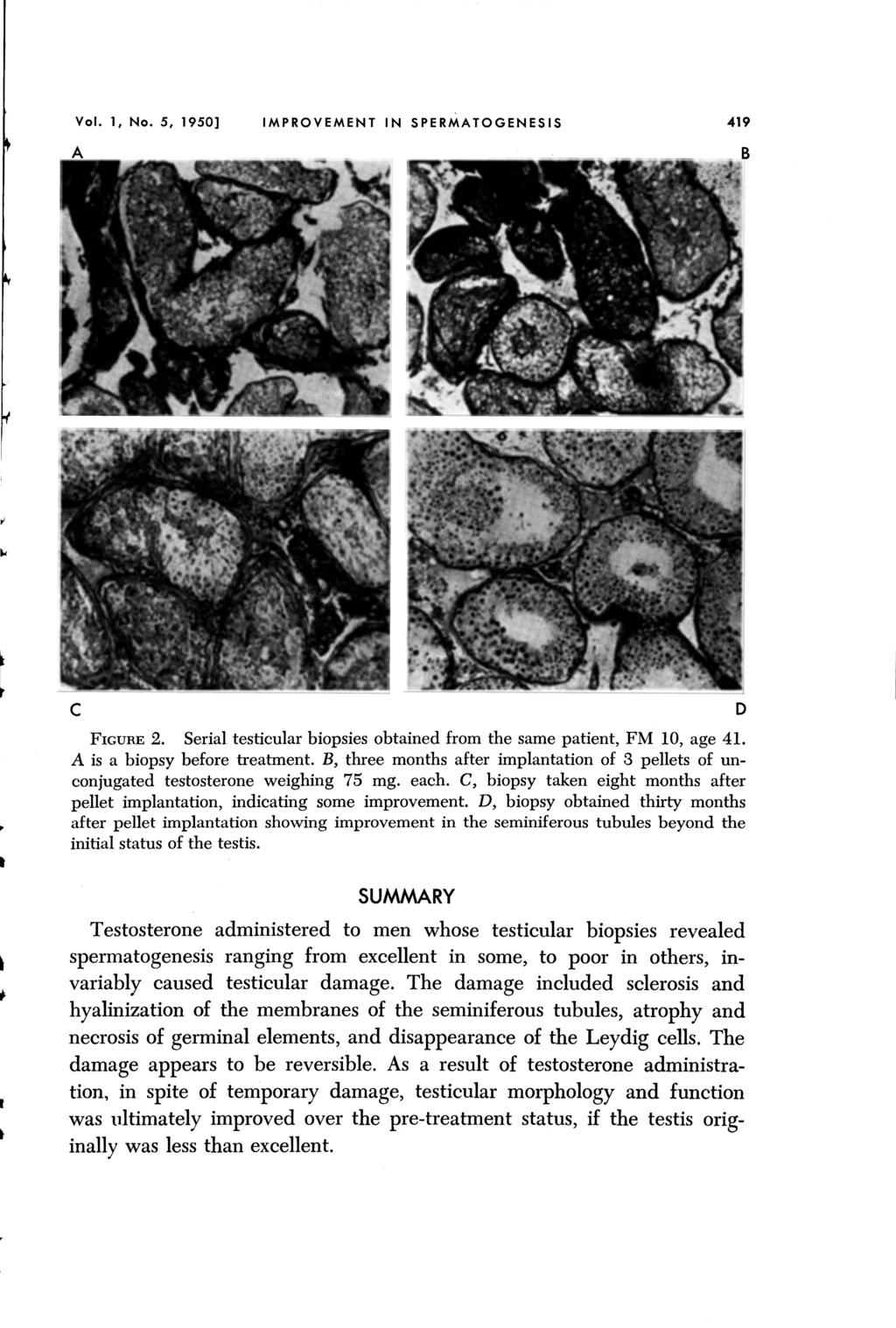 Vol. I, No. 5, 1950] IMPROVEMENT IN SPERMATOGENESIS c 419 D FIGURE 2. Serial testicular biopsies obtained from the same patient, FM 10, age 41. A is a biopsy before treatment.