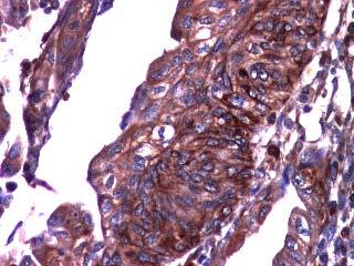 carcinosarcoma (ACT stain, ob.