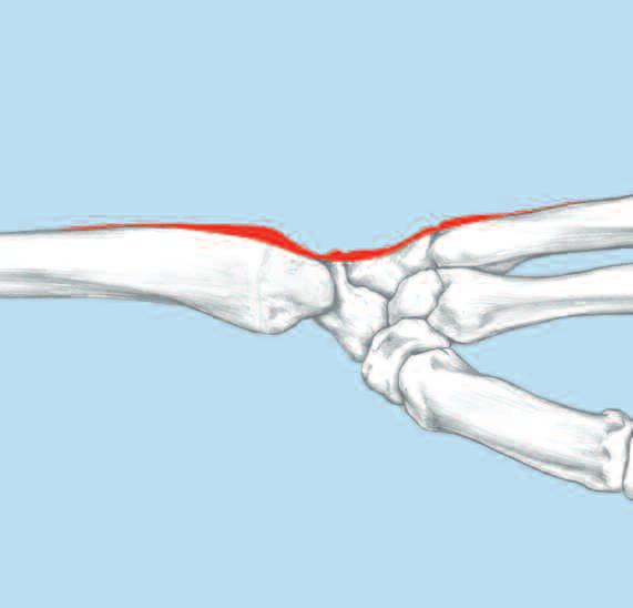 In some cases, the ulnar midcarpal, lunotriquetral and second and third carpometacarpal joints may be included. Remove Lister s tubercle and the dorsal distal aspect of the radius with an osteotome.