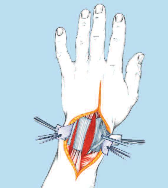 Open the third dorsal compartment, and transpose the extensor pollicis longus (EPL) radially.