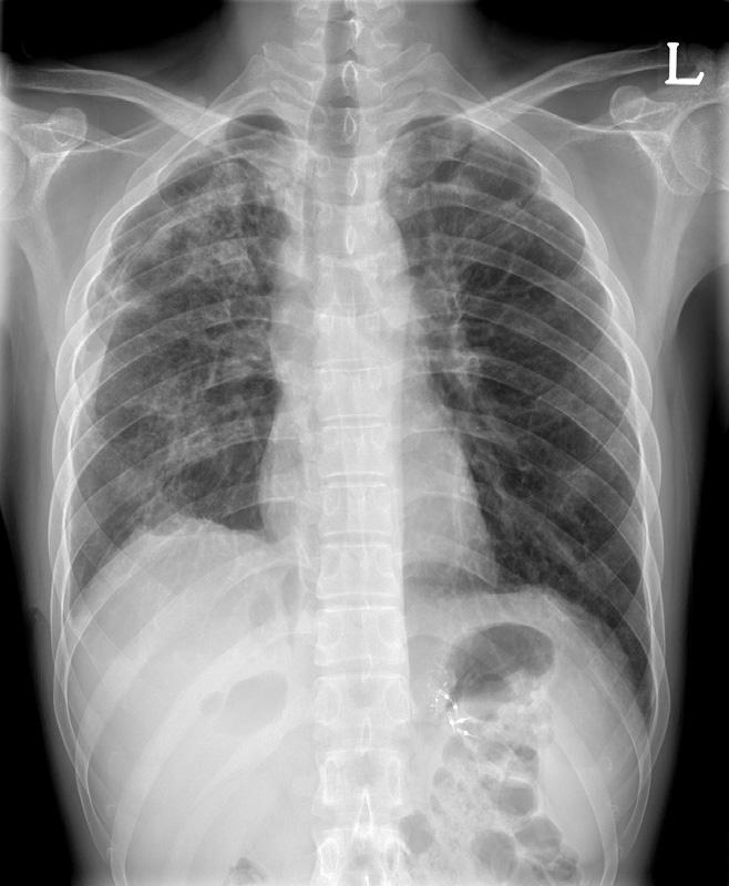 A B C Fig. 1. Chest radiographs initial, extracorporeal membrane oxygenation (ECMO) cannulation, discharge. (A) Initial chest X-ray with dyspnea, patient not intubated with high FiO 2 by facial mask.