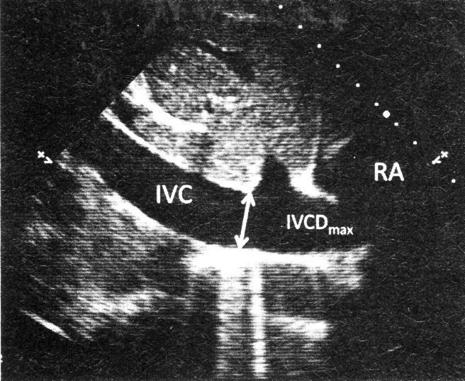 IVC from Subcostal