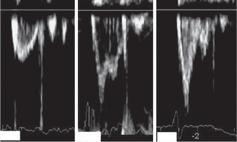 3 Patterns of Pulmonary Flow-Velocity Curves A B C A.