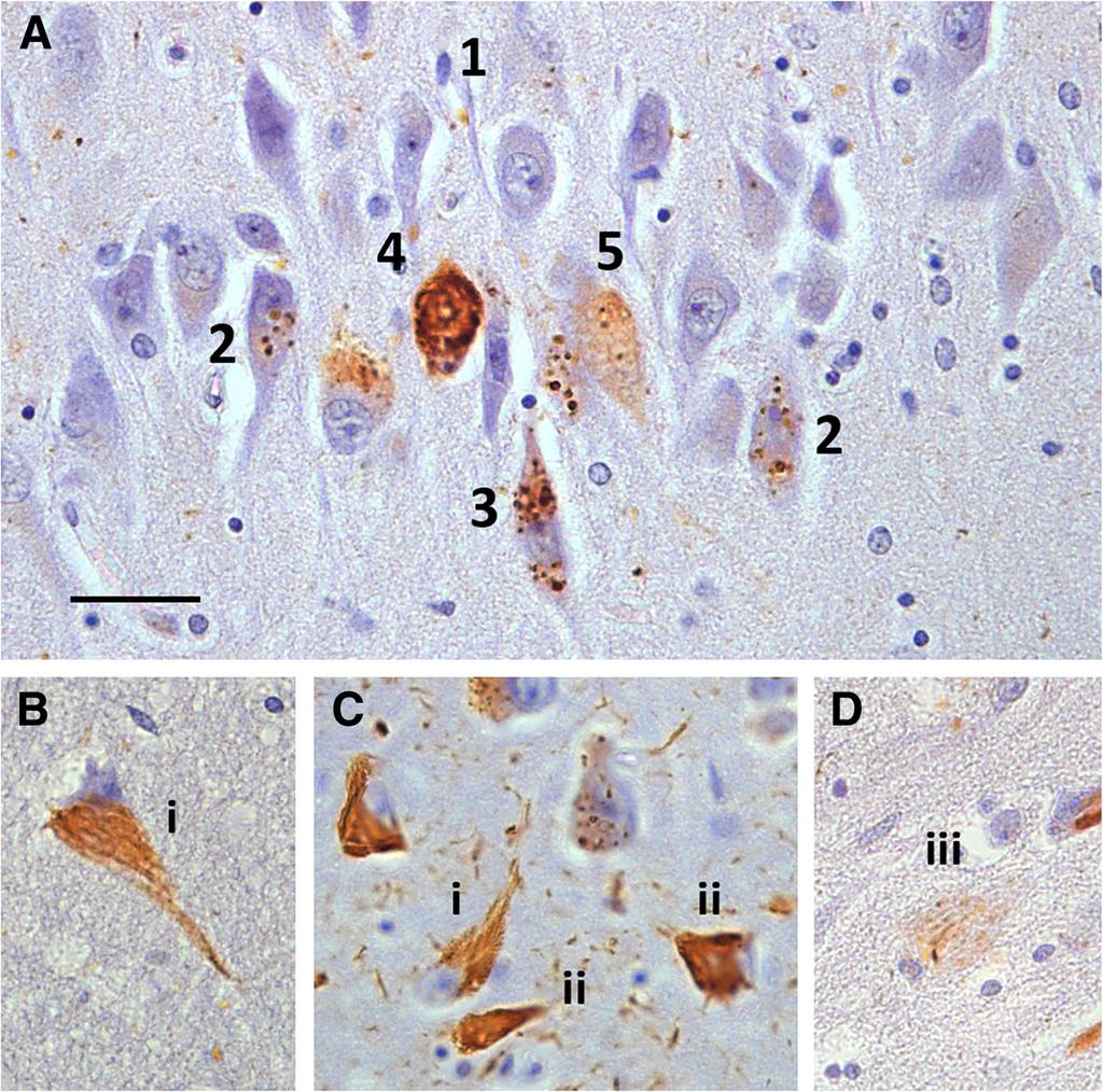 neurons with diffuse tau staining lacking any clear morphology and showing a clear hard line around the nucleus, 5 a neuron with GVD also containing two larger discrete fibrous bundles, *examples of