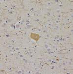 (3R) Pick bodies and ballooned neurons Corticobasal degeneration (CBD) Tauopathy (4R) NFT,