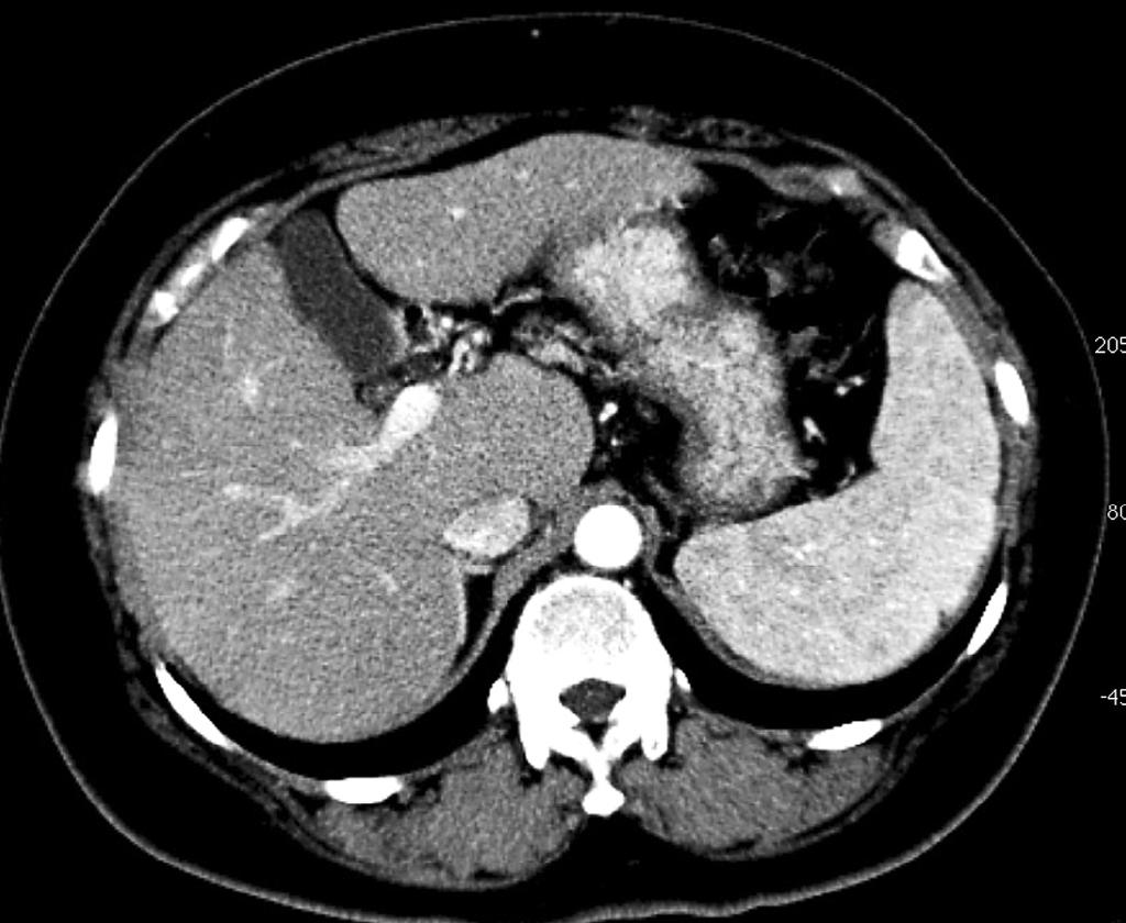 Figure 1. Abdominal CT showing liver deformity and splenomegaly, indicating advanced chronic liver disease. No hepatocellular carcinoma or ascites was evident. Table 1. WBC 6.9 10 3 / mm 3 T-Bil 0.
