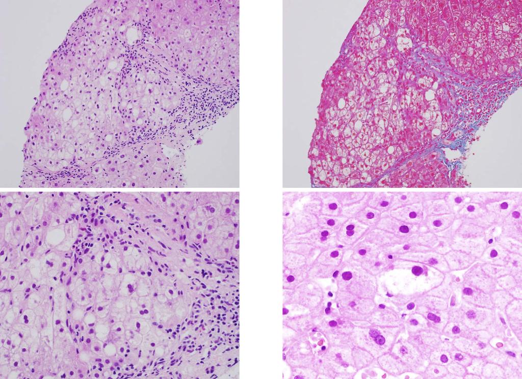 a b c d Figure 2. Liver pathology at the time of the initial diagnosis (a). Hematoxylin and Eosin (H&E) staining shows mild interface hepatitis in the portal area.