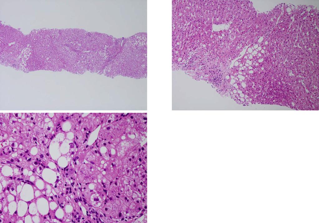 a b c Figure 5. Liver histology after steroid therapy.