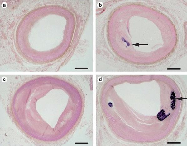 Coronary atherosclerosis in CKD Stages CKD 1-2 CKD 3 CKD 3b