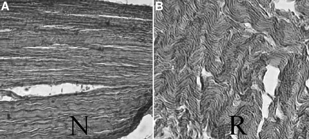 338 T. C. BATTAGLIA AND M. D. MILLER FIG. 2. Comparable images of collagen fibril orientation in native (A) and regenerate (B) rabbit hamstring 28 weeks after harvest. the regenerate.