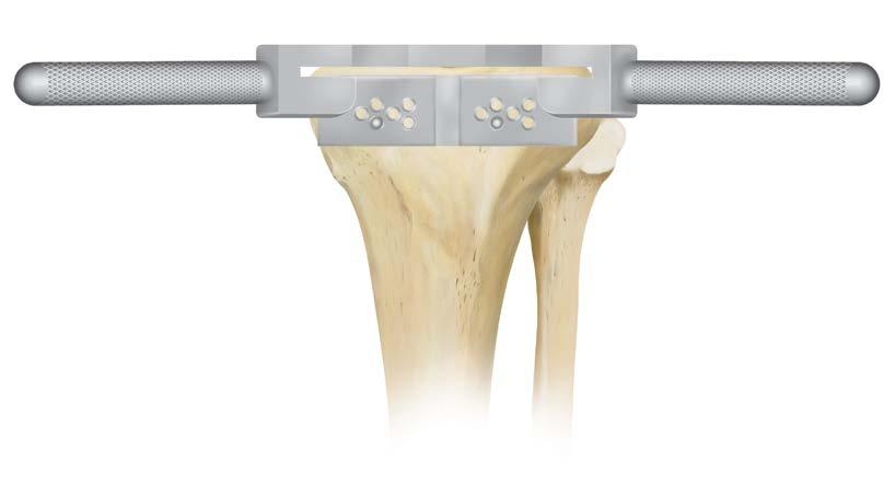 Since the fixation pin holes of all tibial cutting blocks are parallel to the cutting surface, this block will only alter the varus/valgus angle by 2 degrees and will not affect the posterior slope.