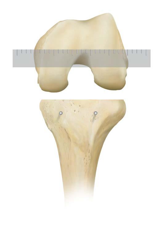 FEMORAL SIZING Center Line Articular Cartilageˇ Lateral View (figure 20) (figure 21) Select a femoral sizing template.