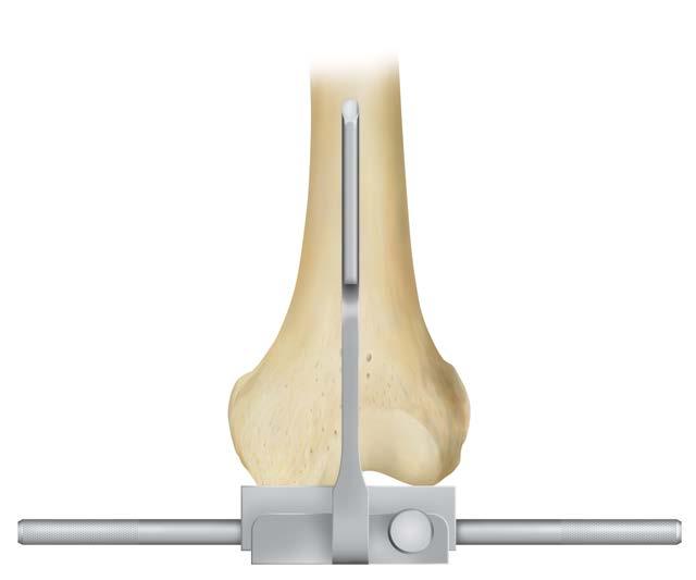 canal by positioning the yoke centrally on the anterior femoral shaft