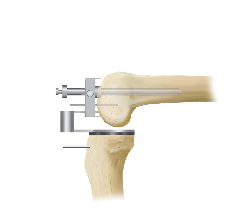 ligament tension is achieved (Figure 28). Evaluate tibial alignment once more by sliding the external alignment rod through the femoral positioner (Figure 29).