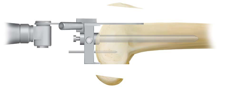A/P FEMORAL RESECTION (figure 30) (figure 31) Attach the saw capture and cut the anterior and posterior femoral condyles.