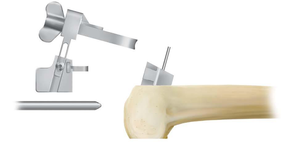 The modular cutting block should rest flush on the anterior femoral cut. Secure it in place by predrilling and inserting two pins through the marked center row of holes.