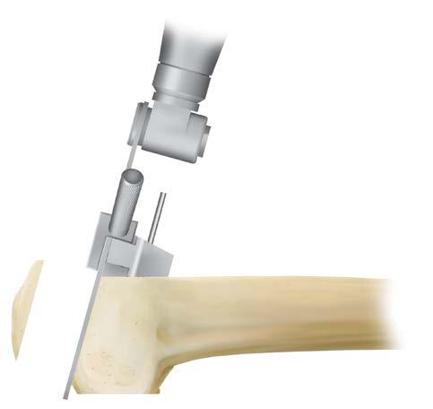 To ensure accuracy, the tibial cutting block may be repositioned on the retained tibial pins, flush against the resected tibia.