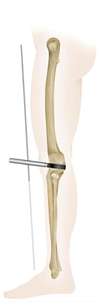 If the spacer block is parallel and aligns with the tibial cut while medial and lateral tissues are equally tensioned, the distal femoral cutting block is correctly located.