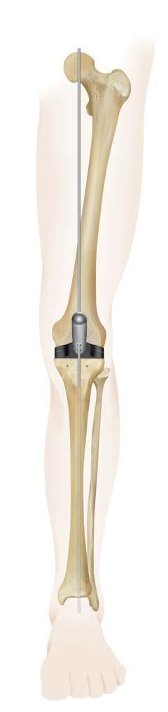 Note: Before proceeding, if necessary, correct either the distal-femoral or proximal-tibial cut to assure equal flexion and extension gaps.