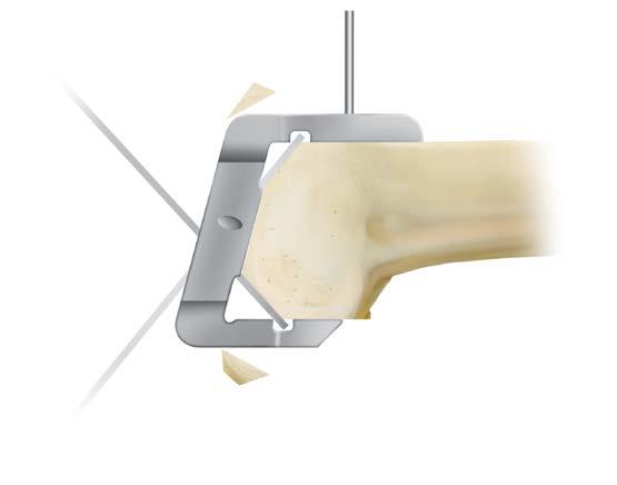 FEMORAL FINISHING RESECTION (figure 42) (figure 40) (figure 43) (figure 41) (figure 44) Flex the knee. Center the finishing guide between the epicondyles and impact it until fully seated.