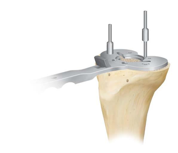 TIBIAL PLATEAU PREPARATION CENTRAL STEM PREPARATION Drill Bushing (figure 45) (figure 46) (figure 47) (figure 48) Connect the tibial tray alignment handle to the MBT tray trial by retracting the