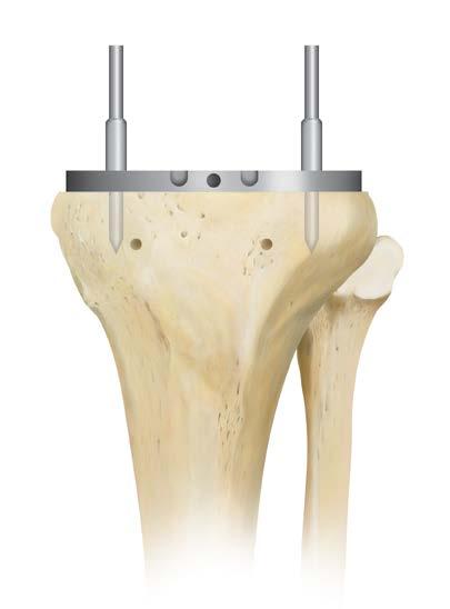 ANY size tray can be used with any size tibial insert since the insert cone is the same for all sizes.