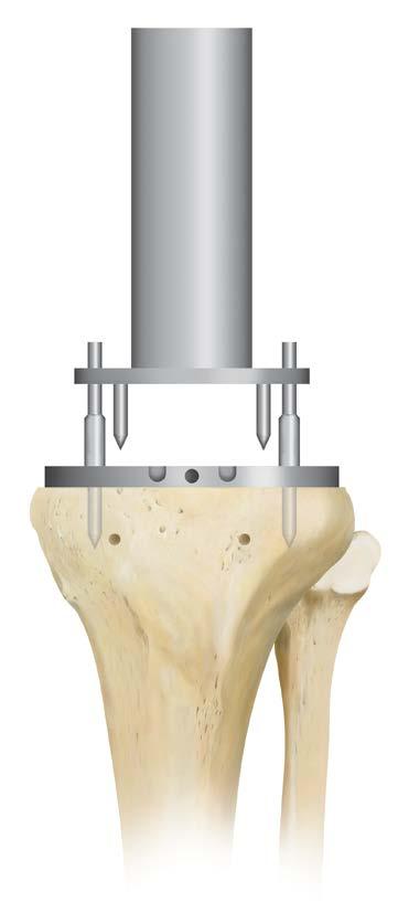 refer to the femoral/tibial sizing matrix on page 28 to assure adequate rotation with the chosen tibial and insert components.